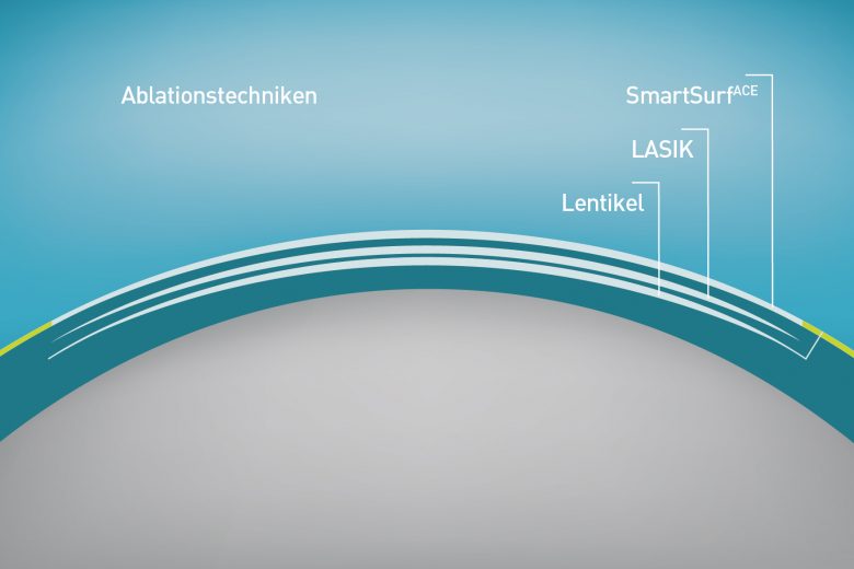 Die modernsten Laser Verfahren im Vergleich