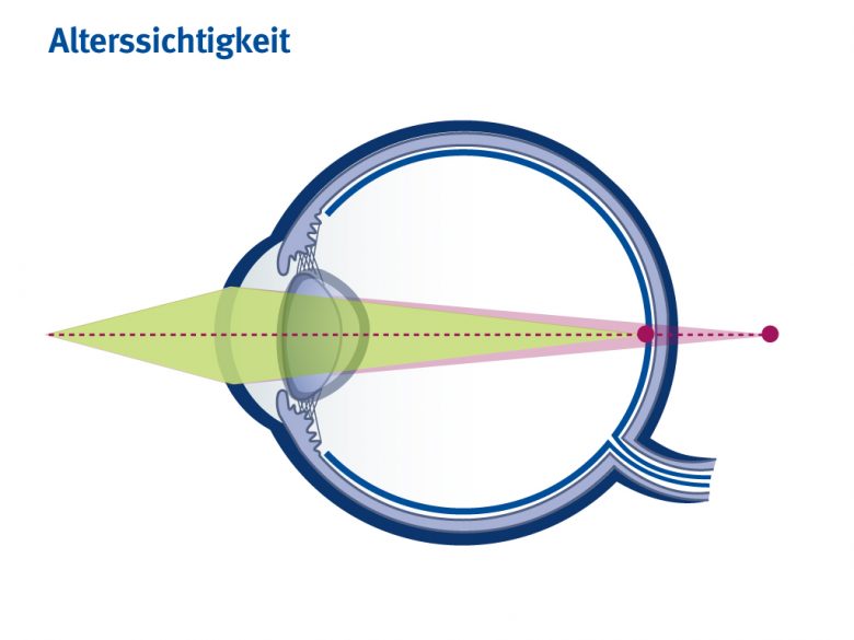 Wenn die Linse nicht mehr elastisch genug ist, verkrümmt sie sich nicht mehr. Der Ältere kann ohne Brille seine Speisekarte nicht mehr lesen