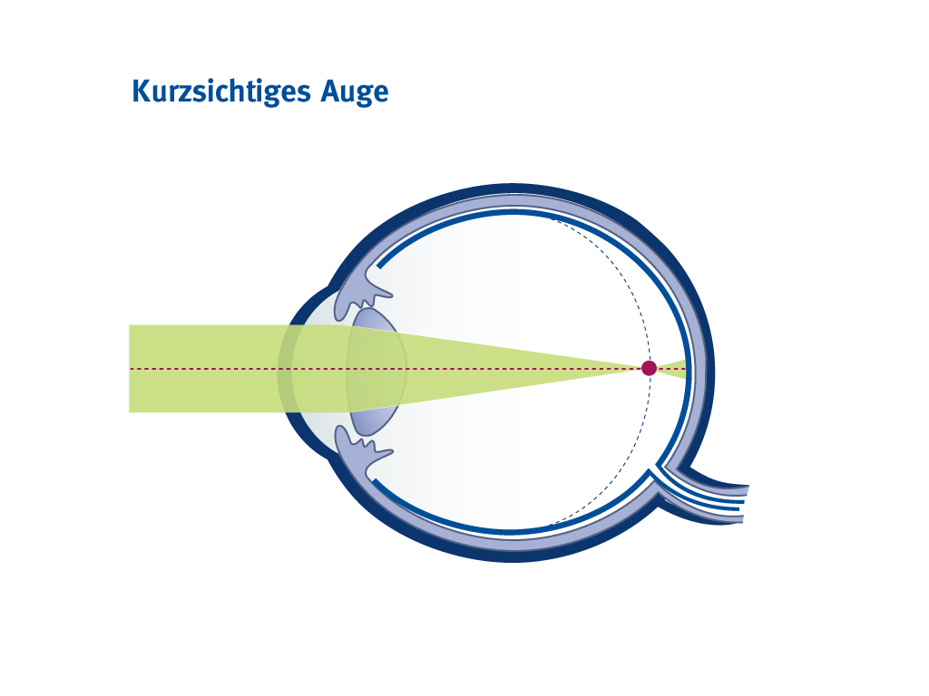 kurzsichtigkeit