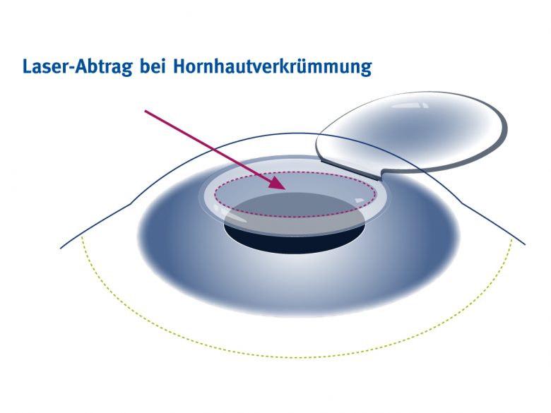 Hornhautverkrümmung lasern mit einem ellipsoiden Laserabtrag