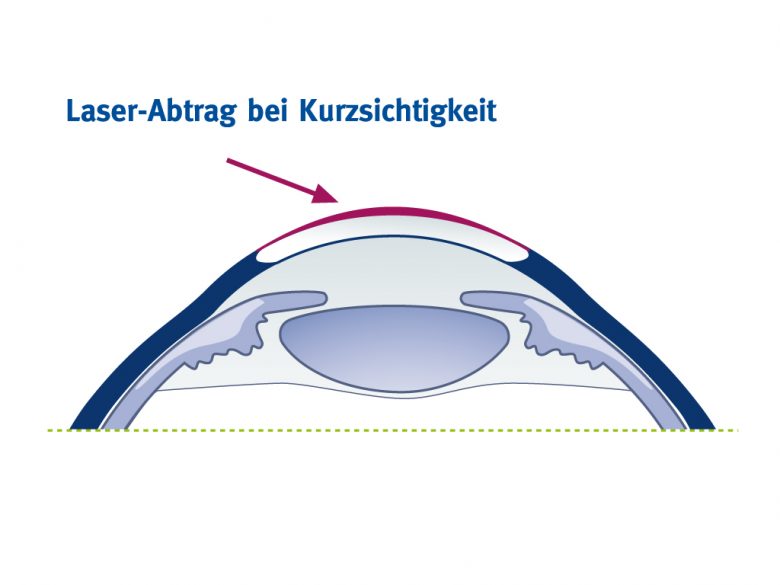 Laserabtrag bei Kurzsichtigkeit