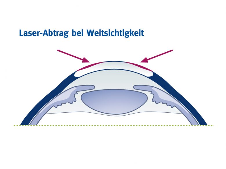 Abtragsprofil bei Weitsichtigkeit