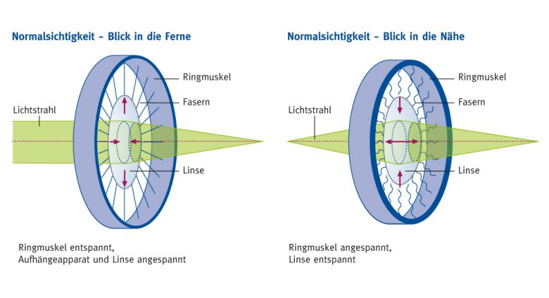 Naheinstellungsreaktion